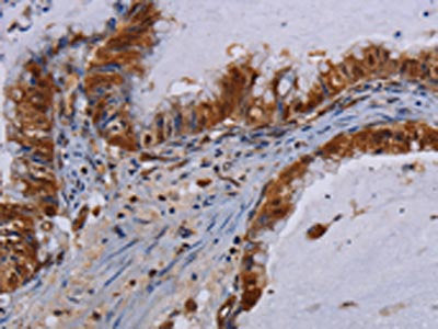 The image on the left is immunohistochemistry of paraffin-embedded Human esophagus cancer tissue using CSB-PA440474(MECP2 Antibody) at dilution 1/60, on the right is treated with fusion protein. (Original magnification: ×200)