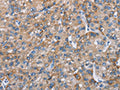 The image on the left is immunohistochemistry of paraffin-embedded Human liver cancer tissue using CSB-PA440550(CHDH Antibody) at dilution 1/25, on the right is treated with fusion protein. (Original magnification: ×200)