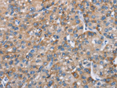 The image on the left is immunohistochemistry of paraffin-embedded Human liver cancer tissue using CSB-PA440550(CHDH Antibody) at dilution 1/25, on the right is treated with fusion protein. (Original magnification: ×200)