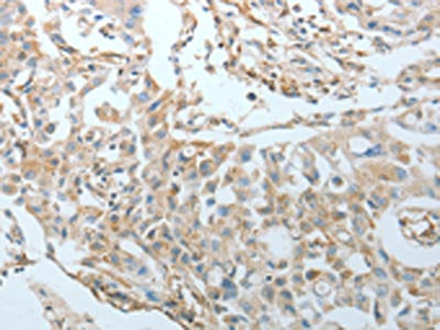 The image on the left is immunohistochemistry of paraffin-embedded Human ovarian cancer tissue using CSB-PA440612(CRMP1 Antibody) at dilution 1/20, on the right is treated with fusion protein. (Original magnification: ×200)