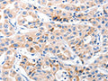 The image on the left is immunohistochemistry of paraffin-embedded Human lung cancer tissue using CSB-PA440881(CDK7 Antibody) at dilution 1/30, on the right is treated with fusion protein. (Original magnification: X200)