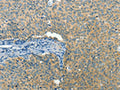 The image on the left is immunohistochemistry of paraffin-embedded Human cervical cancer tissue using CSB-PA440945(BCAT1 Antibody) at dilution 1/50, on the right is treated with fusion protein. (Original magnification: ×200)
