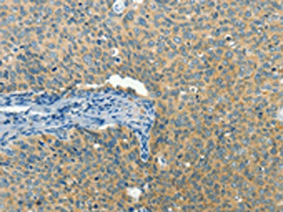 The image on the left is immunohistochemistry of paraffin-embedded Human cervical cancer tissue using CSB-PA440945(BCAT1 Antibody) at dilution 1/50, on the right is treated with fusion protein. (Original magnification: ×200)