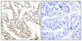 Immunohistochemical analysis of paraffin-embedded human breast carcinoma tissue using Elk-1 (phospho-Thr417) antibody.