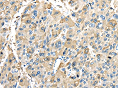 The image on the left is immunohistochemistry of paraffin-embedded Human liver cancer tissue using CSB-PA442043(INHBB Antibody) at dilution 1/45, on the right is treated with synthetic peptide. (Original magnification: ×200)