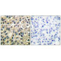 Immunohistochemical analysis of paraffin-embedded human breast carcinoma tissue using Claudin 1 antibody.