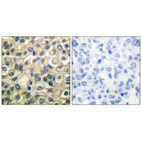 Immunohistochemical analysis of paraffin-embedded human breast carcinoma tissue using Claudin 1 antibody.