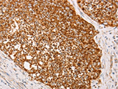 The image on the left is immunohistochemistry of paraffin-embedded Human cervical cancer tissue using CSB-PA443063(AK2 Antibody) at dilution 1/40, on the right is treated with fusion protein. (Original magnification: ×200)