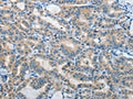 The image on the left is immunohistochemistry of paraffin-embedded Human thyroid cancer tissue using CSB-PA443269(IL21R Antibody) at dilution 1/40, on the right is treated with fusion protein. (Original magnification: ×200)