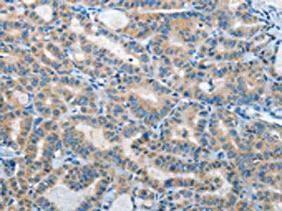 The image on the left is immunohistochemistry of paraffin-embedded Human thyroid cancer tissue using CSB-PA443269(IL21R Antibody) at dilution 1/40, on the right is treated with fusion protein. (Original magnification: ×200)