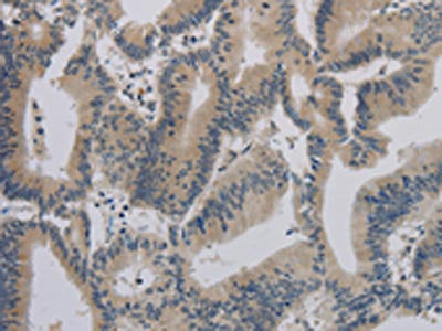 The image on the left is immunohistochemistry of paraffin-embedded Human colon cancer tissue using CSB-PA443536(ACVR1B Antibody) at dilution 1/30, on the right is treated with synthetic peptide. (Original magnification: ×200)