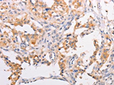 The image on the left is immunohistochemistry of paraffin-embedded Human thyroid cancer tissue using CSB-PA443599(MYLK3 Antibody) at dilution 1/30, on the right is treated with fusion protein. (Original magnification: ×200)