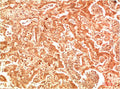 Immunohistochemical analysis of paraffin-embedded Human Hepatocarcinoma Tissue using ATG7 Rabbit pAb diluted at 1:200