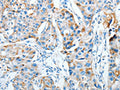 The image on the left is immunohistochemistry of paraffin-embedded Human breast cancer tissue using CSB-PA443866(AGA Antibody) at dilution 1/20, on the right is treated with fusion protein. (Original magnification: ×200)