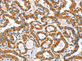The image on the left is immunohistochemistry of paraffin-embedded Human thyroid cancer tissue using CSB-PA444394(AIFM3 Antibody) at dilution 1/40, on the right is treated with fusion protein. (Original magnification: ×200)