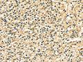 The image on the left is immunohistochemistry of paraffin-embedded Human prostate cancer tissue using CSB-PA444621(LAMA4 Antibody) at dilution 1/20, on the right is treated with fusion protein. (Original magnification: ×200)