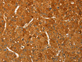 The image on the left is immunohistochemistry of paraffin-embedded Human liver cancer tissue using CSB-PA444635(RPL26L1 Antibody) at dilution 1/20, on the right is treated with fusion protein. (Original magnification: ×200)