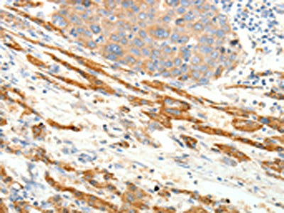 The image on the left is immunohistochemistry of paraffin-embedded Human liver cancer tissue using CSB-PA444792(PTHLH Antibody) at dilution 1/20, on the right is treated with fusion protein. (Original magnification: ×200)