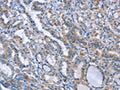 The image on the left is immunohistochemistry of paraffin-embedded Human thyroid cancer tissue using CSB-PA444926(LRRK2 Antibody) at dilution 1/20, on the right is treated with fusion protein. (Original magnification: ×200)