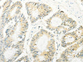 The image on the left is immunohistochemistry of paraffin-embedded Human colon cancer tissue using CSB-PA445195(TRAF1 Antibody) at dilution 1/20, on the right is treated with fusion protein. (Original magnification: ×200)