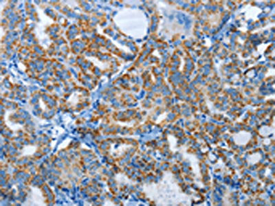 The image on the left is immunohistochemistry of paraffin-embedded Human thyroid cancer tissue using CSB-PA445711(AGL Antibody) at dilution 1/30, on the right is treated with synthetic peptide. (Original magnification: ×200)