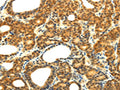 The image on the left is immunohistochemistry of paraffin-embedded Human thyroid cancer tissue using CSB-PA446167(SOCS5 Antibody) at dilution 1/20, on the right is treated with fusion protein. (Original magnification: ×200)