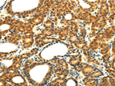 The image on the left is immunohistochemistry of paraffin-embedded Human thyroid cancer tissue using CSB-PA446167(SOCS5 Antibody) at dilution 1/20, on the right is treated with fusion protein. (Original magnification: ×200)