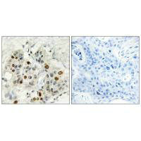 Immunohistochemistry analysis of paraffin-embedded human breast carcinoma tissue, using AF4 antibody.