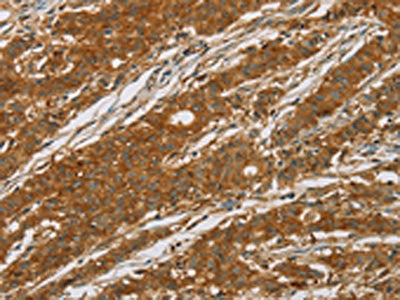 The image on the left is immunohistochemistry of paraffin-embedded Human gastic cancer tissue using CSB-PA446866(CYP27A1 Antibody) at dilution 1/50, on the right is treated with fusion protein. (Original magnification: ×200)