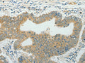 The image on the left is immunohistochemistry of paraffin-embedded Human colon cancer tissue using CSB-PA446984(CCND1 Antibody) at dilution 1/50, on the right is treated with fusion protein. (Original magnification: ×200)
