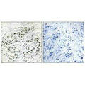 Immunohistochemistry analysis of paraffin-embedded human breast carcinoma tissue, using ERF antibody.