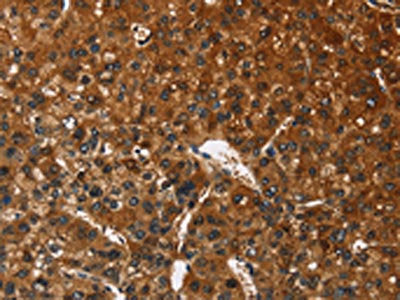 The image on the left is immunohistochemistry of paraffin-embedded Human liver cancer tissue using CSB-PA447681(CATSPER4 Antibody) at dilution 1/50, on the right is treated with fusion protein. (Original magnification: ×200)