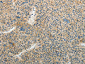 The image on the left is immunohistochemistry of paraffin-embedded Human liver cancer  tissue using CSB-PA447714(TFPI2 Antibody) at dilution 1/25, on the right is treated with fusion protein. (Original magnification: ×200)