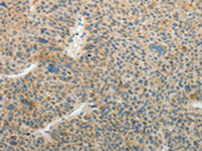 The image on the left is immunohistochemistry of paraffin-embedded Human liver cancer  tissue using CSB-PA447714(TFPI2 Antibody) at dilution 1/25, on the right is treated with fusion protein. (Original magnification: ×200)