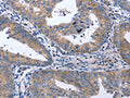 The image on the left is immunohistochemistry of paraffin-embedded Human cervical cancer tissue using CSB-PA447744(NPPB Antibody) at dilution 1/40, on the right is treated with synthetic peptide. (Original magnification: ×200)