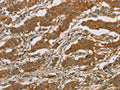 The image on the left is immunohistochemistry of paraffin-embedded Human gastic cancer tissue using CSB-PA447749(CYP39A1 Antibody) at dilution 1/50, on the right is treated with fusion protein. (Original magnification: ×200)
