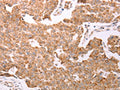 The image on the left is immunohistochemistry of paraffin-embedded Human breast cancer tissue using CSB-PA447966(SMAD5 Antibody) at dilution 1/20, on the right is treated with fusion protein. (Original magnification: ×200)