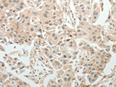 The image on the left is immunohistochemistry of paraffin-embedded Human ovarian cancer tissue using CSB-PA447968(ABCB11 Antibody) at dilution 1/15, on the right is treated with synthetic peptide. (Original magnification: ×200)