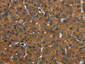 The image on the left is immunohistochemistry of paraffin-embedded Human liver cancer tissue using CSB-PA448841(ID2 Antibody) at dilution 1/30, on the right is treated with fusion protein. (Original magnification: ×200)