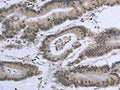 The image on the left is immunohistochemistry of paraffin-embedded Human colon cancer tissue using CSB-PA448901(EID1 Antibody) at dilution 1/20, on the right is treated with fusion protein. (Original magnification: ×200)