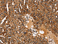 The image on the left is immunohistochemistry of paraffin-embedded Human breast cancer tissue using CSB-PA449173(KCNH6 Antibody) at dilution 1/30, on the right is treated with fusion protein. (Original magnification: ×200)