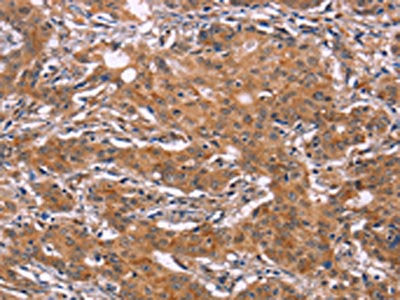 The image on the left is immunohistochemistry of paraffin-embedded Human gastic cancer tissue using CSB-PA449475(NR4A2 Antibody) at dilution 1/20, on the right is treated with fusion protein. (Original magnification: ×200)