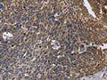 The image is immunohistochemistry of paraffin-embedded Human cervical cancer tissue using CSB-PA449695(GABPB2 Antibody) at dilution 1/30. (Original magnification: ×200)