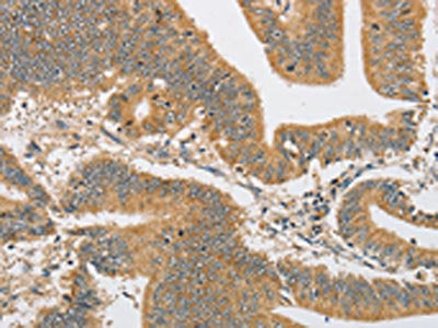 The image on the left is immunohistochemistry of paraffin-embedded Human colon cancer tissue using CSB-PA449930(ARHGAP15 Antibody) at dilution 1/30, on the right is treated with fusion protein. (Original magnification: ×200)