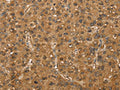 The image on the left is immunohistochemistry of paraffin-embedded Human liver cancer tissue using CSB-PA458397(SETD2 Antibody) at dilution 1/30, on the right is treated with fusion protein. (Original magnification: ×200)