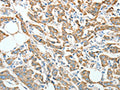 The image on the left is immunohistochemistry of paraffin-embedded Human breast cancer tissue using CSB-PA461581(AGR3 Antibody) at dilution 1/10, on the right is treated with fusion protein. (Original magnification: ×200)