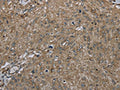 The image on the left is immunohistochemistry of paraffin-embedded Human esophagus cancer tissue using CSB-PA469305(CLPS Antibody) at dilution 1/45, on the right is treated with fusion protein. (Original magnification: ×200)