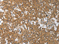 The image on the left is immunohistochemistry of paraffin-embedded Human breast cancer tissue using CSB-PA475447(PXN Antibody) at dilution 1/30, on the right is treated with synthetic peptide. (Original magnification: ×200)
