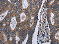 The image on the left is immunohistochemistry of paraffin-embedded Human colon cancer tissue using CSB-PA476221(GSTA3 Antibody) at dilution 1/30, on the right is treated with fusion protein. (Original magnification: ×200)