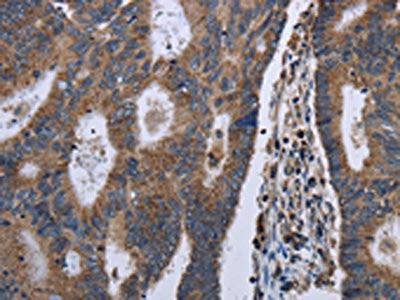 The image on the left is immunohistochemistry of paraffin-embedded Human colon cancer tissue using CSB-PA476221(GSTA3 Antibody) at dilution 1/30, on the right is treated with fusion protein. (Original magnification: ×200)